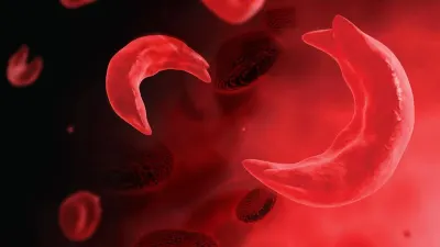 African drugmakers develop local treatments for sickle cell disease — Cape Times / IOL Cape