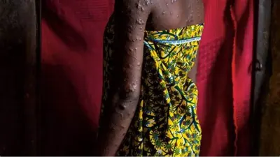 11 African countries record 1,153 mpox cases in six weeks — Premium Times