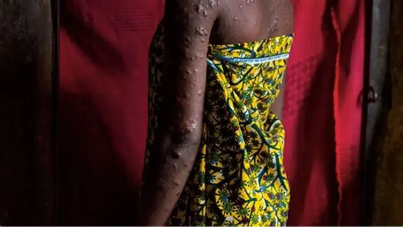 11 African countries record 1,153 mpox cases in six weeks — photograph supplied by Premium Times