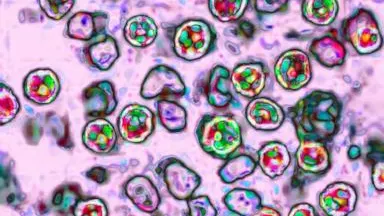 Another measles-related death reported in Pennsylvania as outbreak grows — ABC News (US)
