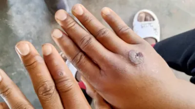 Govt reports suspected anthrax in Muchinga — News Diggers Zambia